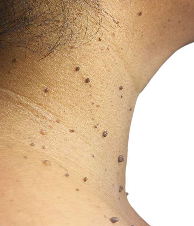 Skin Tag Removal