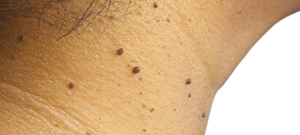 Skin Tag Removal