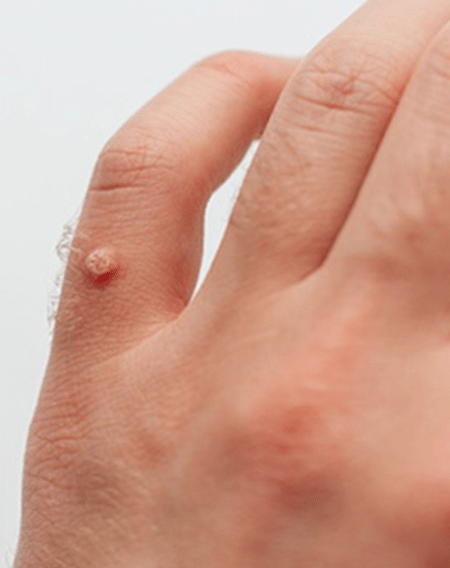 Wart Removal