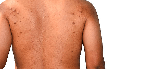 Seborrheic Keratosis Removal