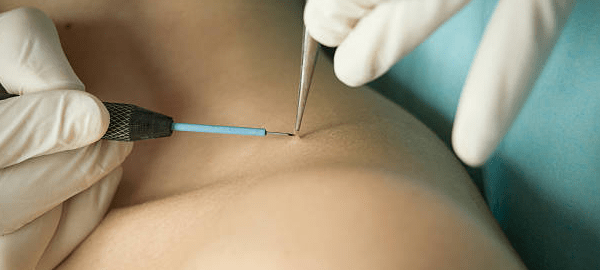 Skin Tag Removal