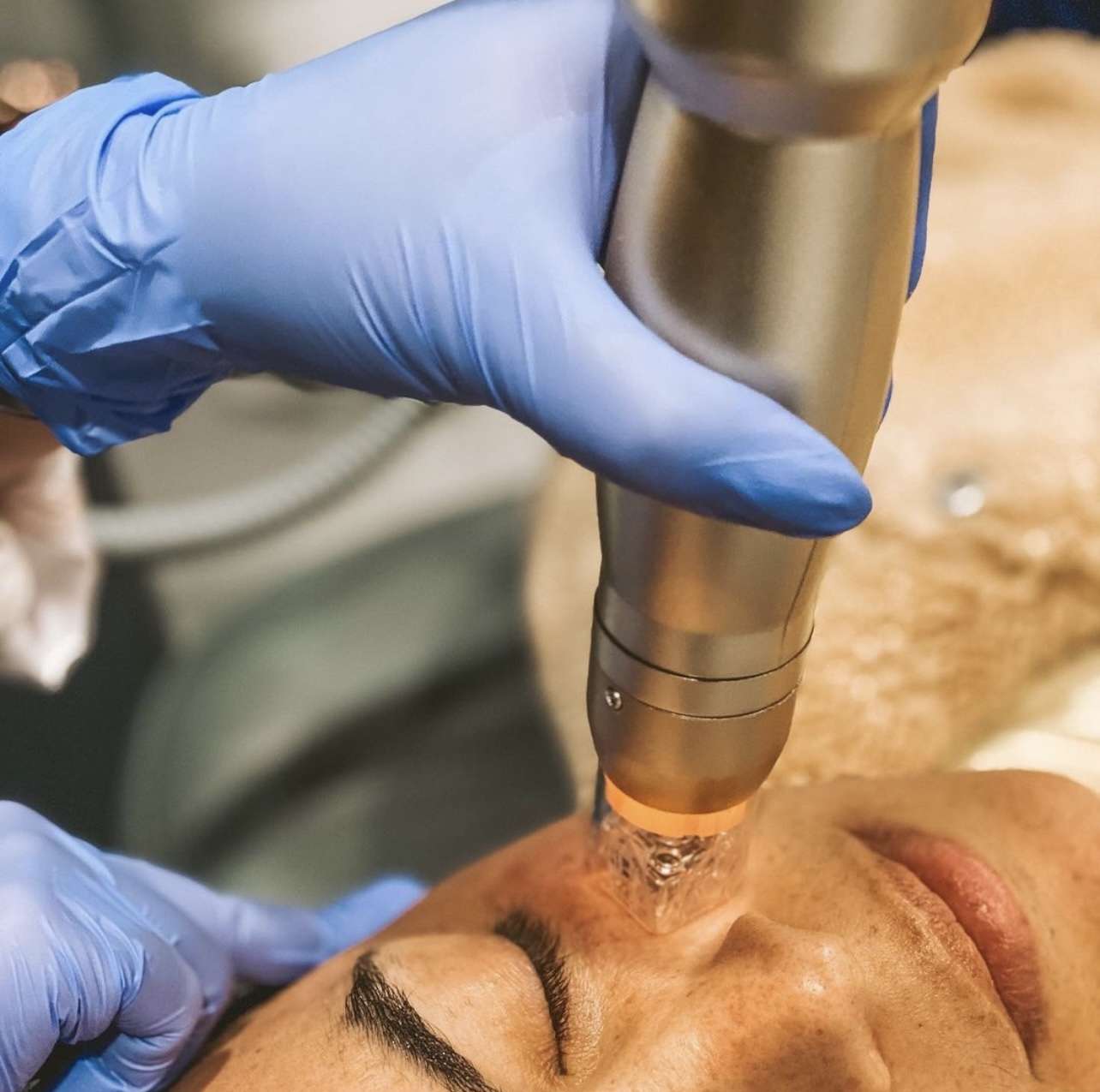 Radiofrequency Microneedling